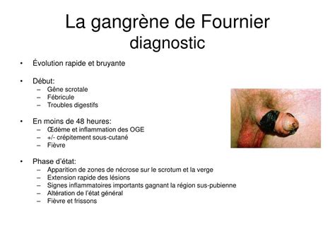 Fournier S Gangrene Pictures