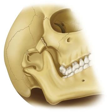 Zygomatic Arch Fracture Treatment