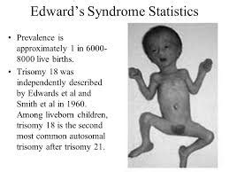 Trisomy 18 known as Edwards Syndrome | Strive For Good Health