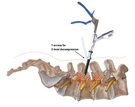 Endoscopic spine surgery: 5 things to know :: Norwest Private Hospital