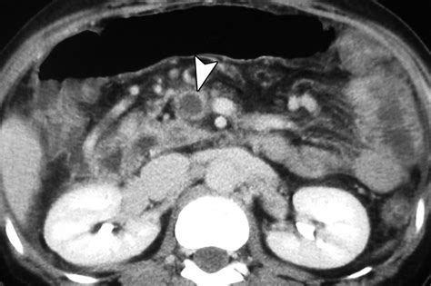 CT Diagnosis of Acute Mesenteric Ischemia from Various Causes | AJR