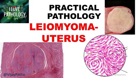 LEIOMYOMA UTERUS: etiology, Clinical features, Gross & Microscopy - YouTube