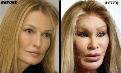 Jocelyn Wildenstein Before & After Surgery Pictures - Plastic Surgery Diary