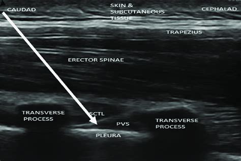 Sonographic image showing technique of paravertebral block with needle... | Download Scientific ...