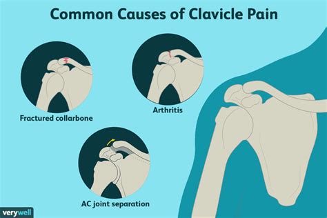 Collarbone Pain: 10 Conditions That Affect the Clavicle