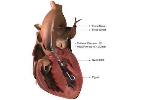 Impella Device | Impella Heart Pump | Kauvery Hospital