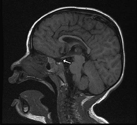 Sagittal T1-weighted MRI of a patient with a postfixed chiasm and ...