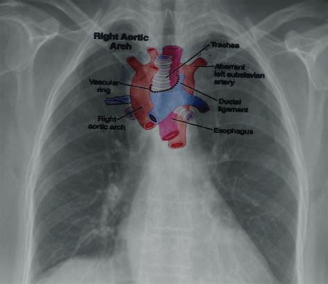 Aortic Ring Surgery