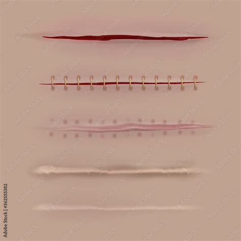 Surgical sutures healing stages. Realistic bloody wound and stitch ...