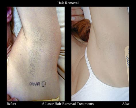 Schemel Konstruieren Unverändert laser hair before and after Verwerfen Geröstet Haufen