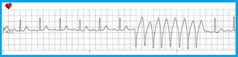 Float Nurse: Practice EKG Strips 429