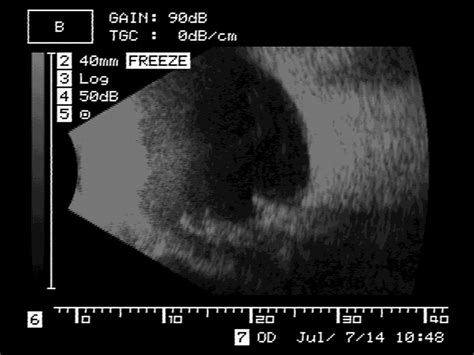 B-mode ultrasound scan of the patient's left eye. A high-luminance... | Download Scientific Diagram