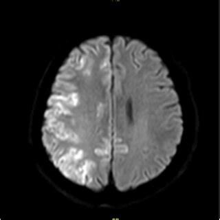 Brain MRI shows widespread cerebral infarction. | Download Scientific Diagram