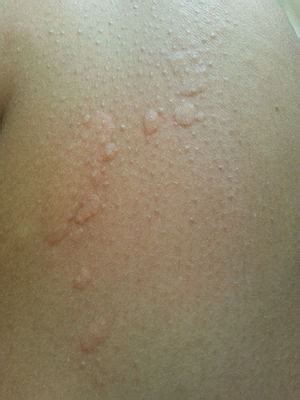 Cold urticaria - Wikipedia