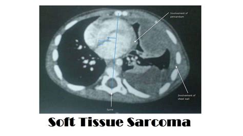 Soft Tissue Sarcoma: 7 Types, Causes, Symptoms, And Diagnosis