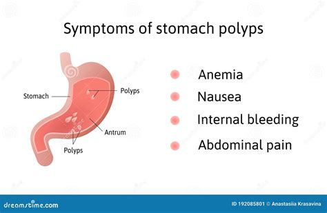 Stomach Polyps Symptoms