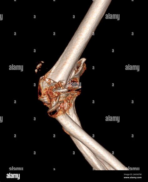 Fractured elbow. Coloured 3D computed tomography (CT) scan of the elbow of an 84-year-old ...