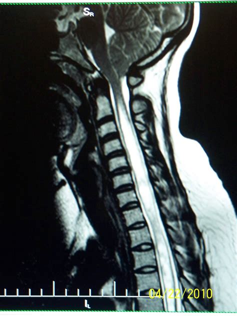 MRI Clinicals: Syrinx and Chiari Malformation