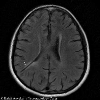 Dr Balaji Anvekar FRCR: CSF shunt imaging