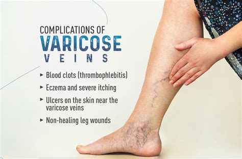 Complications of varicose veins