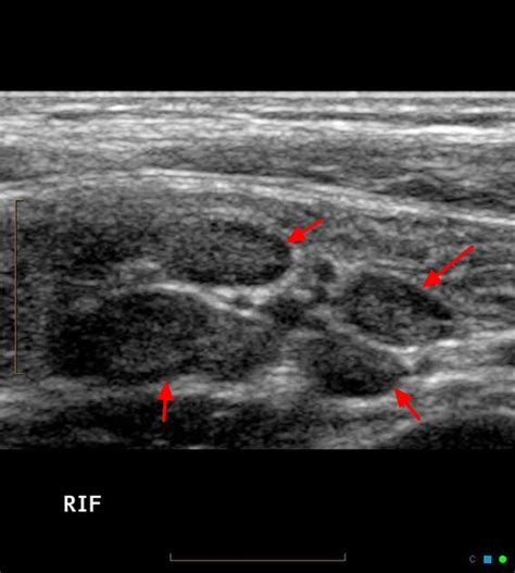 Mesenteric Lymphadenitis - Causes, Symptoms, Prognosis & Treatment