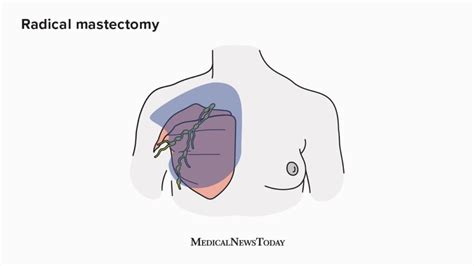 Radical mastectomy: Definition, procedure, and recovery