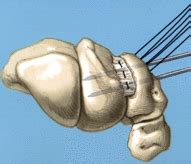 Diagnosis and Treatment of Acute Lunotriquetral Ligament Injuries - Hand Clinics