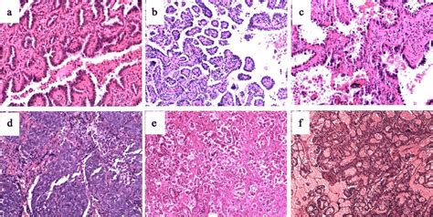 Lung Carcinoma Histology