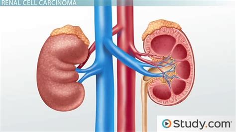 Renal Cancer: Causes & Symptoms - Lesson | Study.com