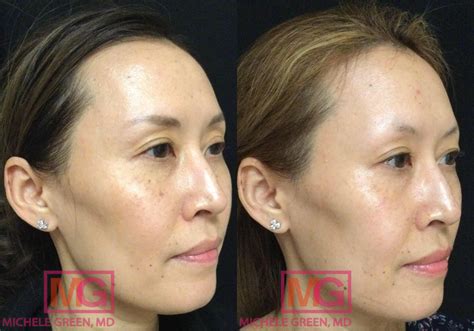 Asian Skin Treatment NYC, Asian Skin Dermatologist