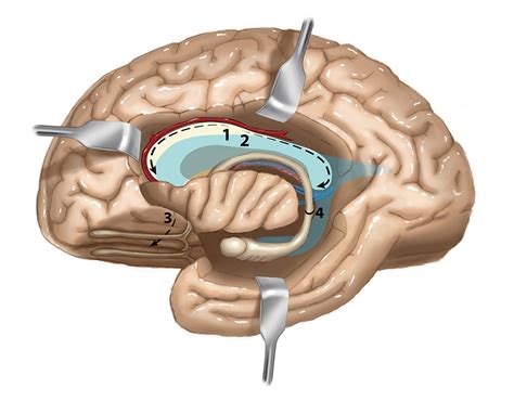 Hemispherectomy on Behance