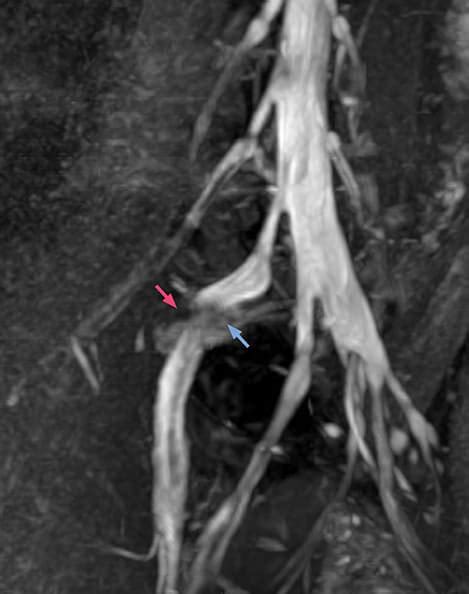 MRI nerve visualization informs surgery | FieldStrength | Philips