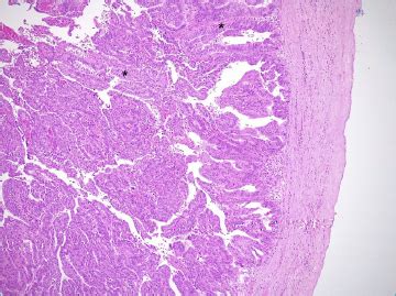 Benign biliary neoplasms and biliary tumour precursors | Pathologica - Journal of the Italian ...