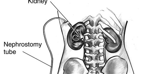 People Thinking Action: Nephrostomy: What works and what does not work?