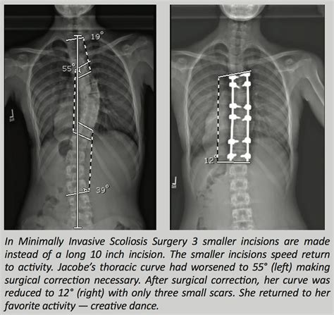 Scoliosis Texas - MInimally Invasive Scoliosis Surgery