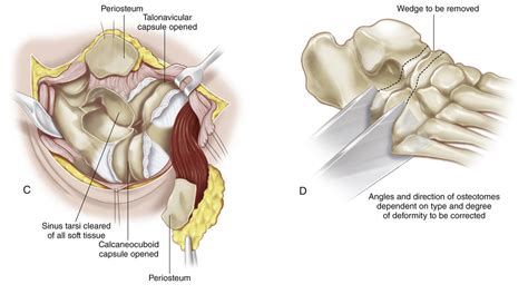 33 Triple Arthrodesis | Musculoskeletal Key