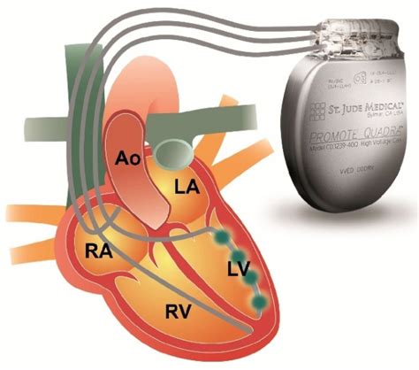 Cardiac resynchronisation therapy • healthcare-in-europe.com