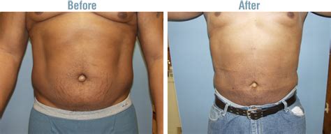 Liposuction Side Effects Are Important - Weight Loss Surgery