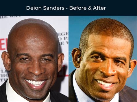 Deion Sanders Hair Transplant