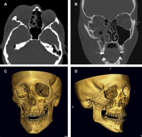 (A) CT axial bone window demonstrating fracture across zygomatic and... | Download Scientific ...