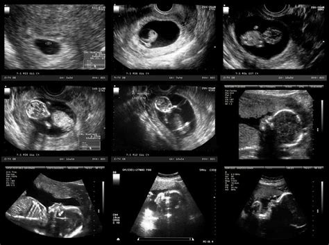 Overview of Early Pregnancy Fetal Development