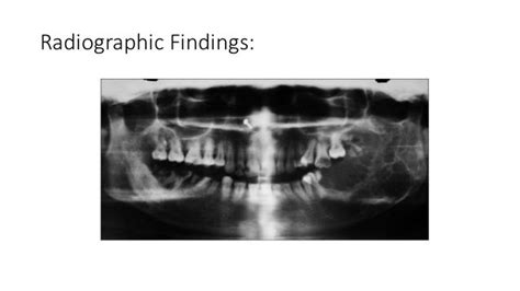 Odontogenic myxoma