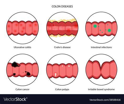 Intestines diseases concept Royalty Free Vector Image