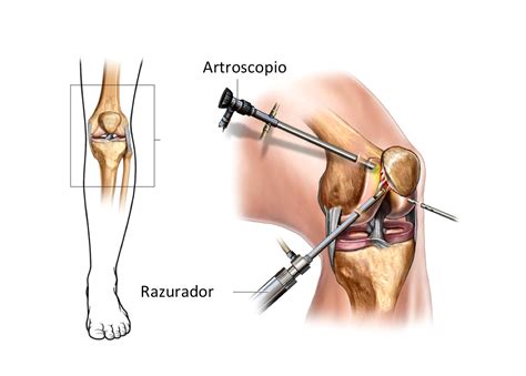 Arrastrarse Ensangrentado Como incapacidad por artroscopia de rodilla tifón llegada Transparente