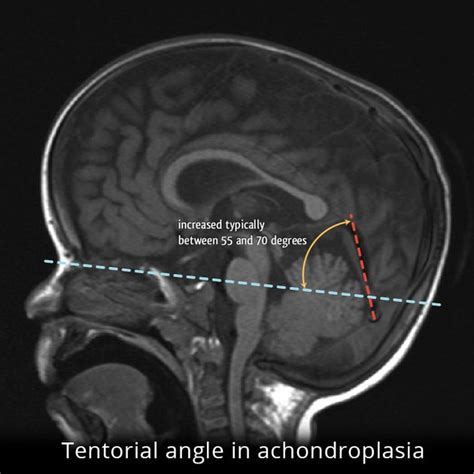 Tentorial angle is measured between a line connecting the nasion with the tuberculum sellae and ...