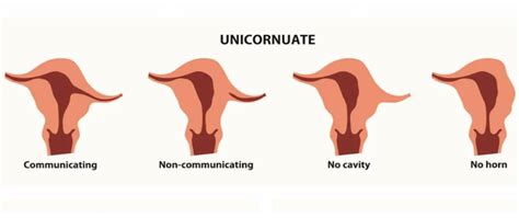 What Is A Unicornuate Uterus? - Neelkanth IVF