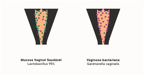 Vaginose bacteriana: razão comum de corrimento vaginal anormal