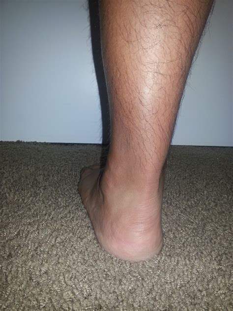 Peroneal Tendon Surgery Recovery: Ankle Time Line (updated for week 10/11)