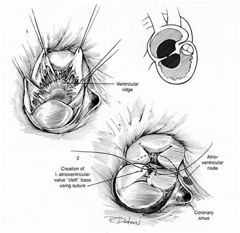 Atrioventricular septal defect surgery - wikidoc