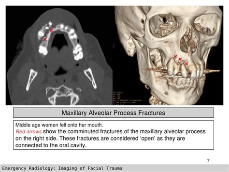 Imaging Of Facial Trauma Part 3